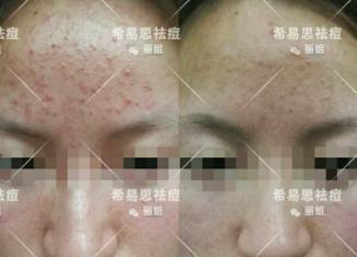 丘疹型痘痘很难治愈吗？会讲韩语的阿梅,第一阶段祛痘成功！
