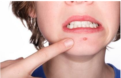 嘴边长痘是什么原因？嘴边长痘是什么引起的？