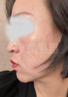 为什么皮肤会变成敏感肌，脸部敏感肌是怎么形成的